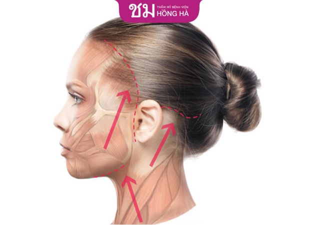 Phẫu thuật căng da mặt toàn phần giúp cải thiện các đường nét trên gương mặt