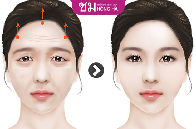 Phẫu thuật căng da vùng trán nội soi mang đến nét tươi trẻ, rạng ngời