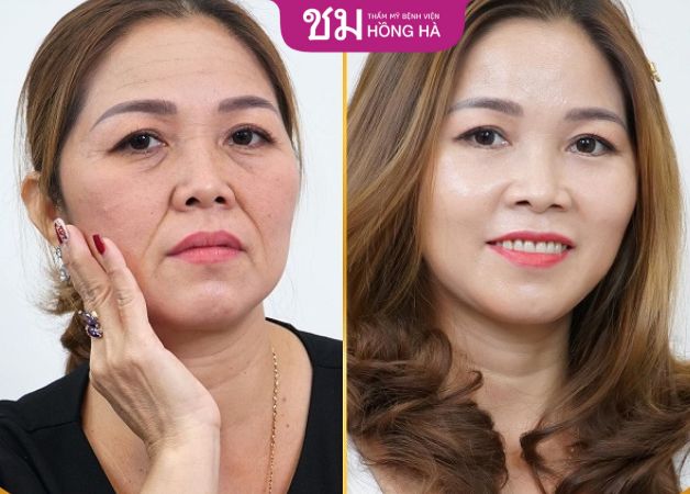 Những dấu hiệu lão hóa vùng trán đều biến mất