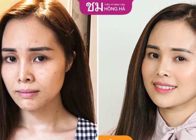 Hình ảnh trước và sau khi thực hiện căng da trán