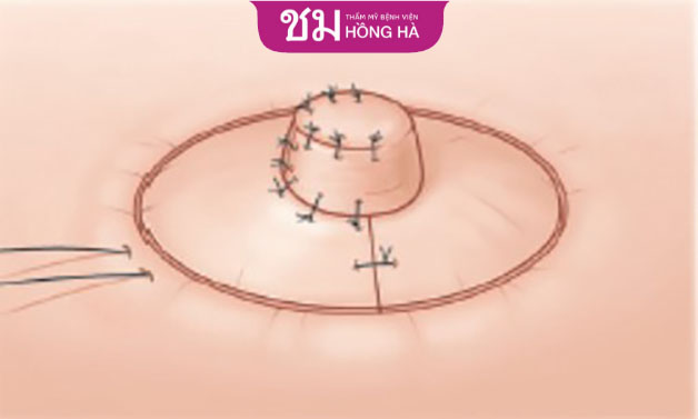 Phương pháp này giúp tạo hình dáng vú tự nhiên vốn có