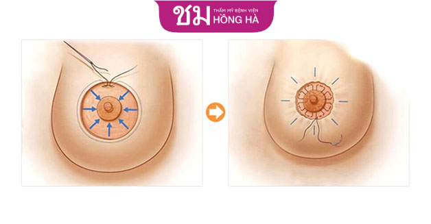 Có 2 phương pháp phổ biến giúp tái tạo quầng và núm vú hiệu quả