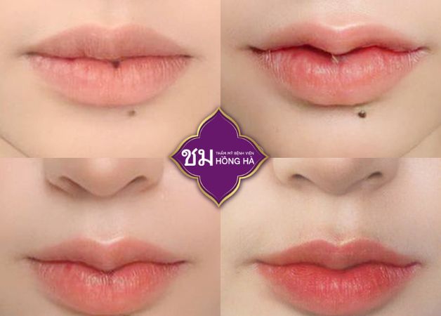Hình ảnh khách hàng sau khi tạo hình môi tại Thẩm mỹ Bệnh viện Hồng Hà