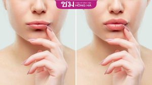 Phẫu thuật tạo hình môi ở đâu đẹp? Các phương pháp thẩm mỹ môi hiện đại