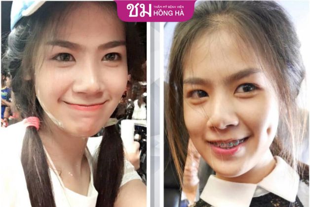 Má lúm như điểm nhấn trên gương mặt khách hàng