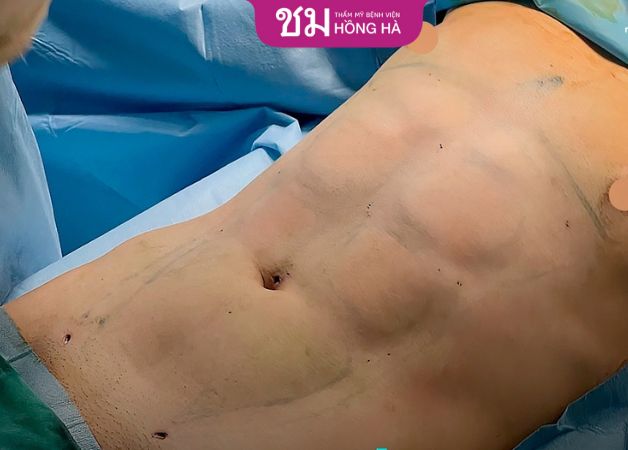 Sau khi hút mỡ bụng, bác sĩ sẽ bắt tay vào tạo hình bụng