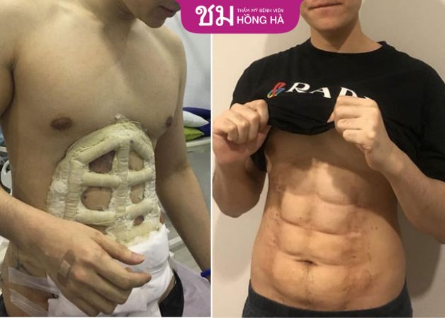 Cơ bụng thấy rõ sau khi phục hồi hoàn toàn