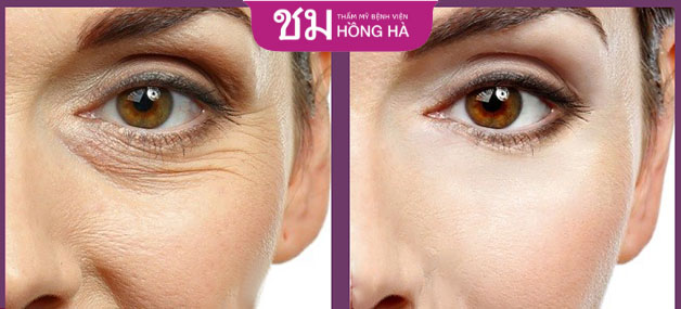 Bước vào độ tuổi trung niên vùng da mí mắt dần bị lão hóa