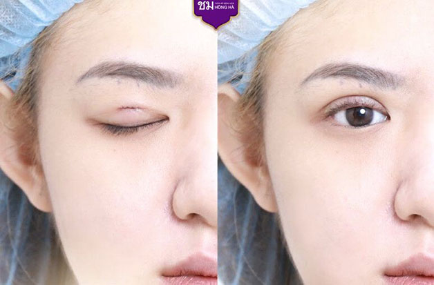 Kết quả khách hàng sau cắt da mí thừa tại Hồng Hà