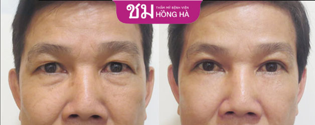 Khách hàng Duy Hùng sau phẫu thuật loại bỏ triệt để tình trạng da mí mắt bị dư thừa