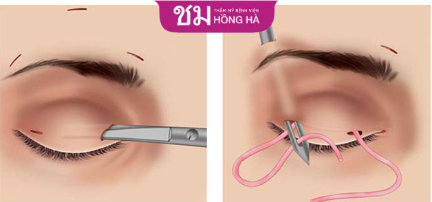 Treo cơ nâng mi sẽ khắc phục hoàn toàn tình trạng lão hóa vùng mắt