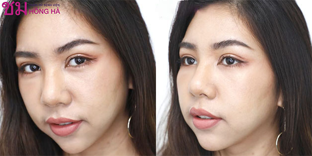 Đôi mắt to tròn, tự nhiên với đường khâu khéo léo giấu trong nếp mí