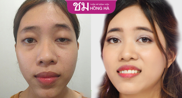 Gương mặt trở lên sắc nét, quyến rũ hơn rất nhiều