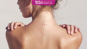 Ý nghĩa của 3 nốt ruồi thẳng hàng trên cơ thể bạn nên biết