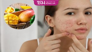 Ăn xoài có nổi mụn không? Lưu ý khi ăn để không gây nóng trong