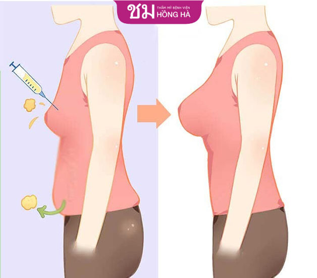 Nâng ngực bằng mỡ tự thân được đánh giá là phương pháp 2 trong 1