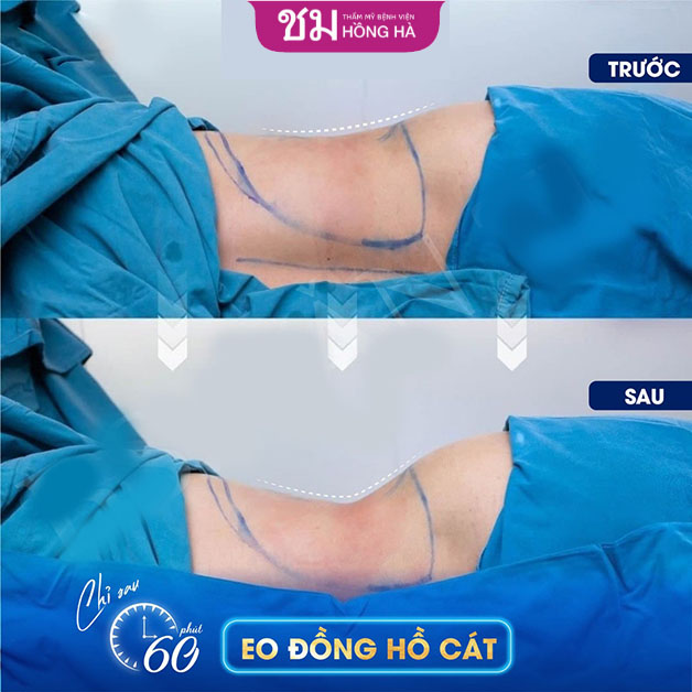 Hút mỡ tại Thẩm mỹ Bệnh viện Hồng Hà là phương pháp hợp lý, an toàn giúp nhanh chóng lấy lại vóc dáng