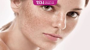 Nguyên nhân và cách khắc phục tình trạng nám cánh bướm