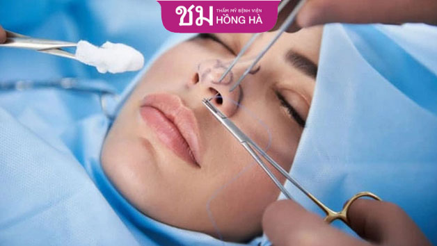 Mũi cấu trúc hoàn toàn có thể tháo sụn và sửa lại được
