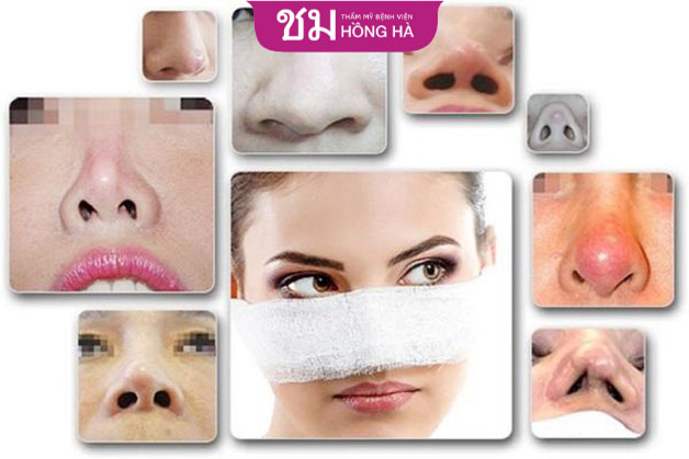 Cần sửa lại khi mũi gặp các vấn đề biến chứng