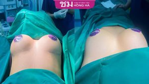 Nâng ngực X – Breast có thực sự tốt như lời đồn?