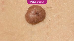 Luận giải ý nghĩa nốt ruồi mọc lông ở từng vị trí trên cơ thể