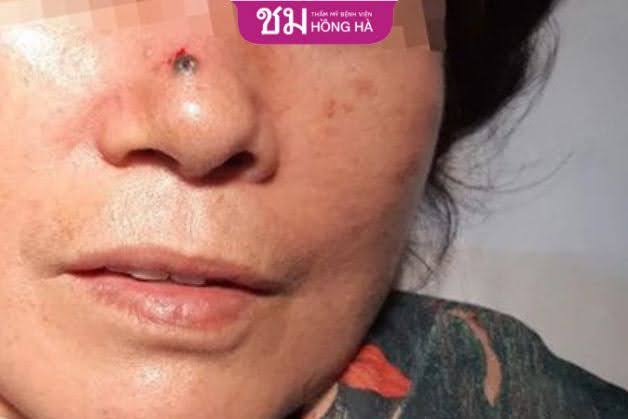 Nốt ruồi có lông trên mũi biểu thị quan hệ xã hội không quá tốt