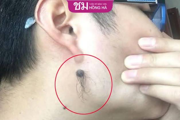 Người có nốt ruồi ở cổ được đánh giá cao về tài năng và sự thông minh