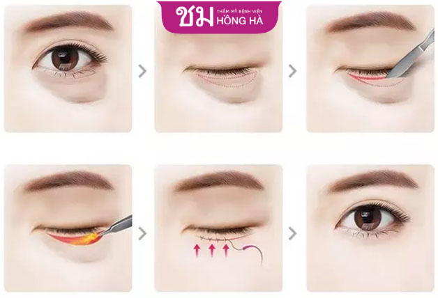 Loại bỏ bọng mắt sẽ giúp trẻ hóa vùng mắt hiệu quả