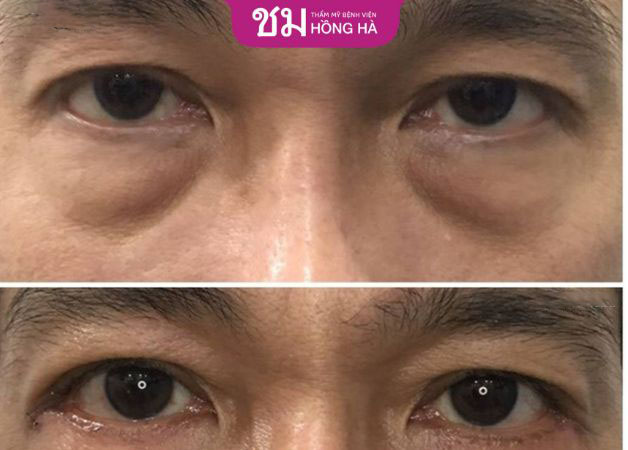 Đôi mắt không còn ủ rũ mà linh hoạt hơn nhiều sau khi xóa bỏ bọng mắt