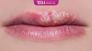 Phun môi bị nổi mụn trắng? hướng dẫn cách chăm sóc hiệu quả