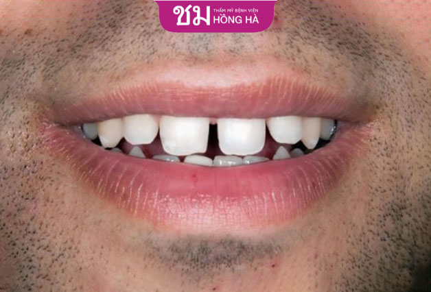 Đây là nét tướng của người thích bịa chuyện, soi mói người khác