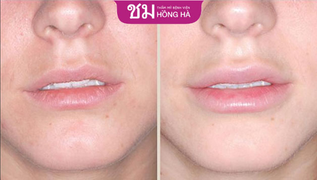 Filler giúp môi đầy đặn hơn nhưng hiệu quả chỉ duy trì trong khoảng 12 - 18 tháng