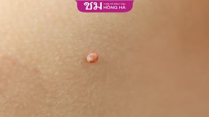 Nốt ruồi ở dương vật có sao không? Khi nào cần thăm khám bác sĩ?