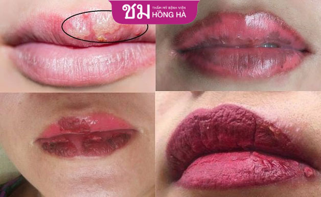 Bất kỳ dấu hiệu bấy thường trên môi đều là vấn đề biến chứng