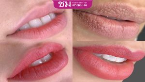 Quy trình phục hồi môi diễn ra như thế nào? Cách chăm sóc