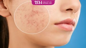 Bí  kíp trị thâm mụn cấp tốc sau 1 đêm đã được kiểm chứng